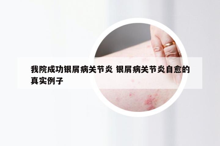 我院成功银屑病关节炎 银屑病关节炎自愈的真实例子