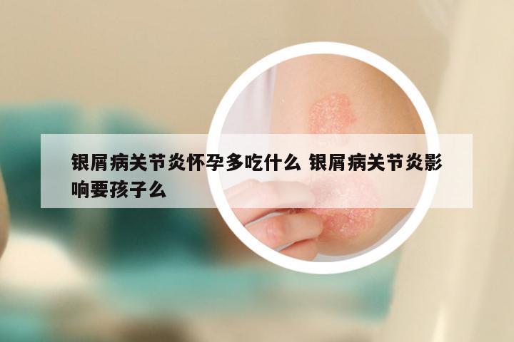 银屑病关节炎怀孕多吃什么 银屑病关节炎影响要孩子么