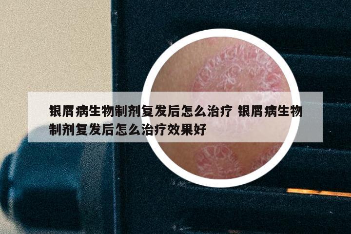 银屑病生物制剂复发后怎么治疗 银屑病生物制剂复发后怎么治疗效果好