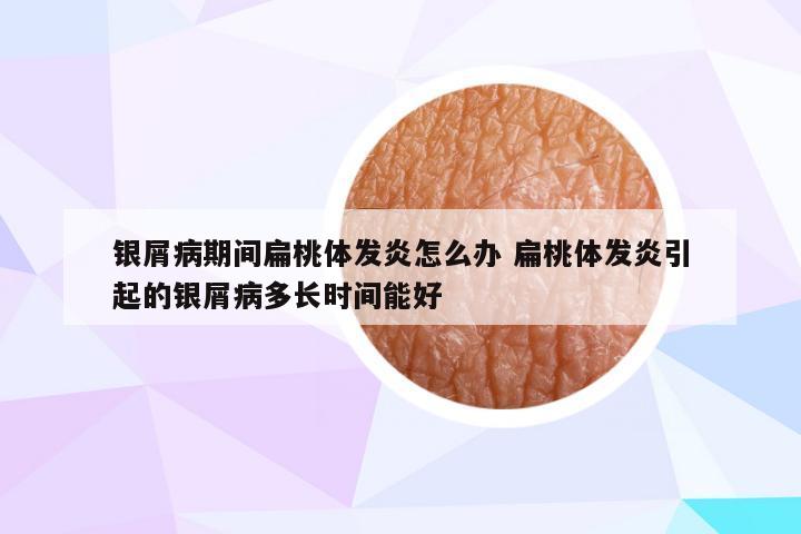 银屑病期间扁桃体发炎怎么办 扁桃体发炎引起的银屑病多长时间能好