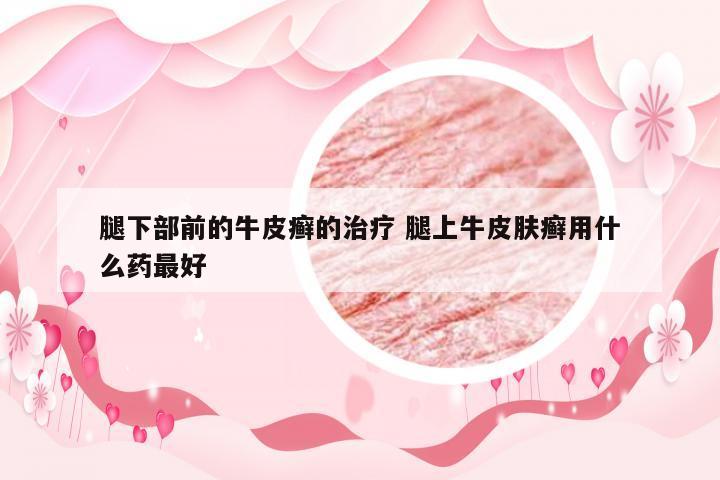 腿下部前的牛皮癣的治疗 腿上牛皮肤癣用什么药最好