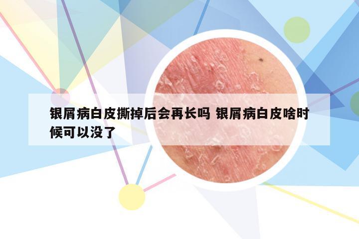 银屑病白皮撕掉后会再长吗 银屑病白皮啥时候可以没了