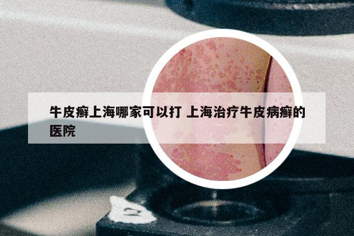 牛皮癣上海哪家可以打 上海治疗牛皮病癣的医院