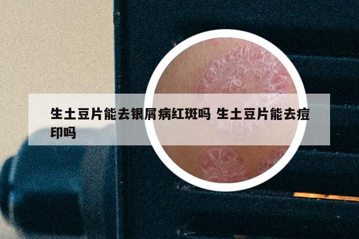 生土豆片能去银屑病红斑吗 生土豆片能去痘印吗