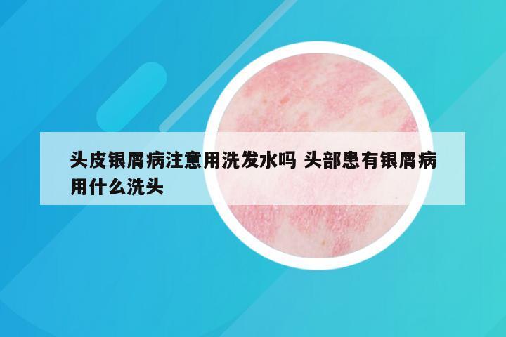 头皮银屑病注意用洗发水吗 头部患有银屑病用什么洗头