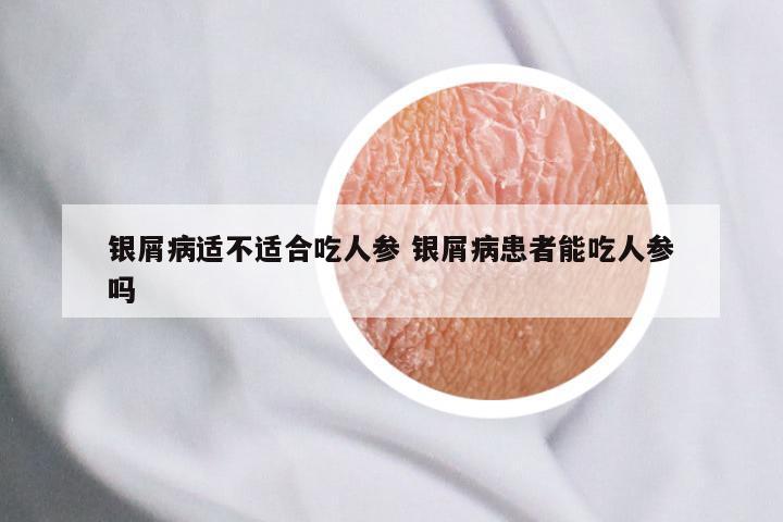 银屑病适不适合吃人参 银屑病患者能吃人参吗