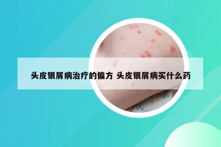 头皮银屑病治疗的偏方 头皮银屑病买什么药