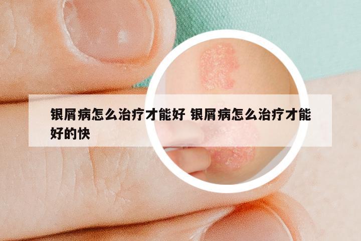 银屑病怎么治疗才能好 银屑病怎么治疗才能好的快