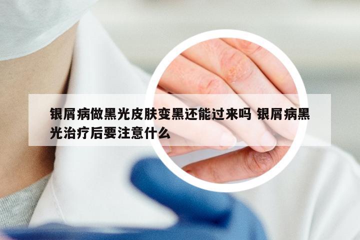 银屑病做黑光皮肤变黑还能过来吗 银屑病黑光治疗后要注意什么