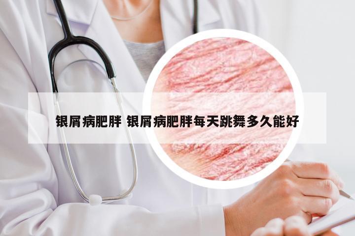 银屑病肥胖 银屑病肥胖每天跳舞多久能好