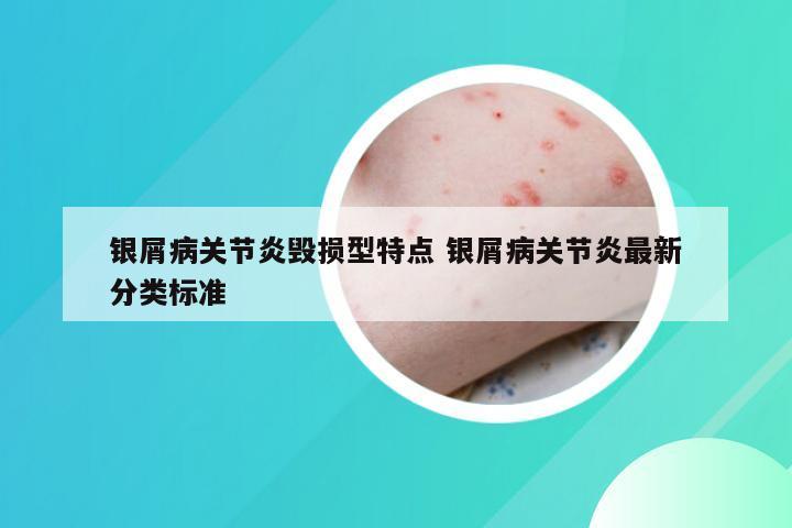 银屑病关节炎毁损型特点 银屑病关节炎最新分类标准