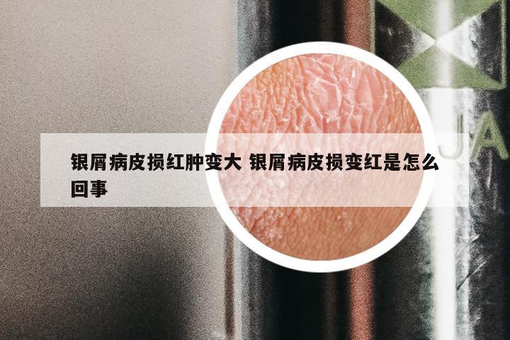 银屑病皮损红肿变大 银屑病皮损变红是怎么回事