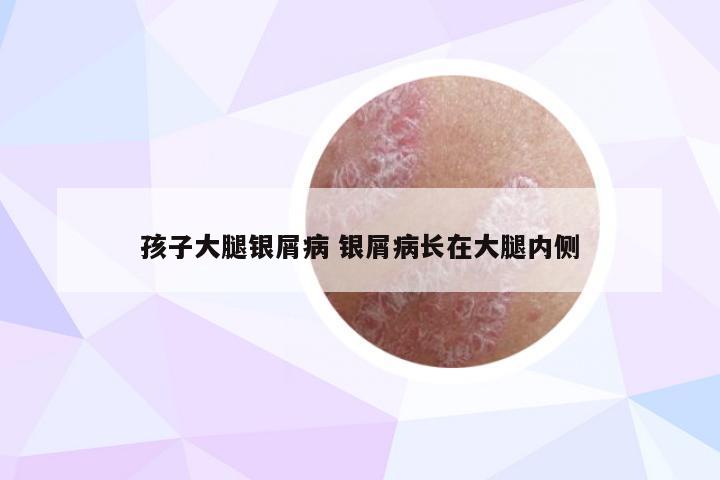 孩子大腿银屑病 银屑病长在大腿内侧