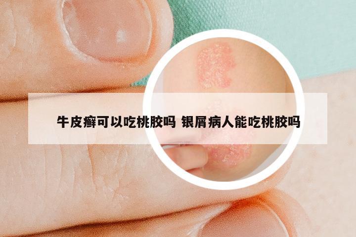 牛皮癣可以吃桃胶吗 银屑病人能吃桃胶吗