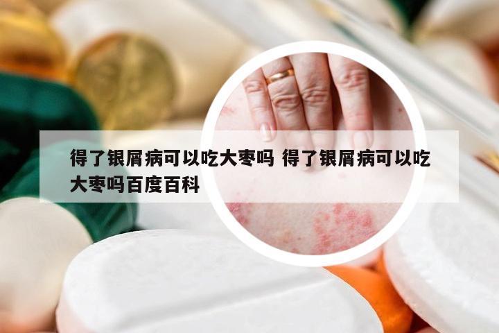 得了银屑病可以吃大枣吗 得了银屑病可以吃大枣吗百度百科