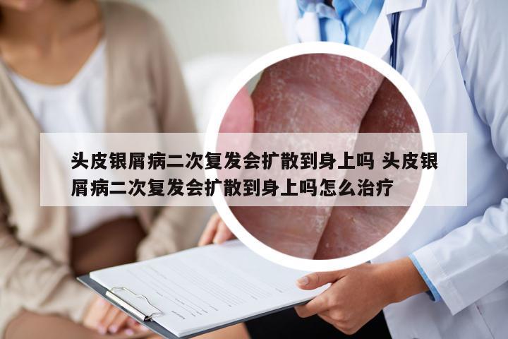 头皮银屑病二次复发会扩散到身上吗 头皮银屑病二次复发会扩散到身上吗怎么治疗