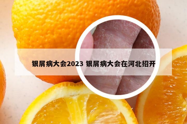 银屑病大会2023 银屑病大会在河北招开