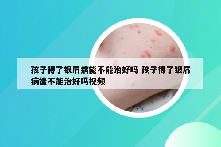 孩子得了银屑病能不能治好吗 孩子得了银屑病能不能治好吗视频