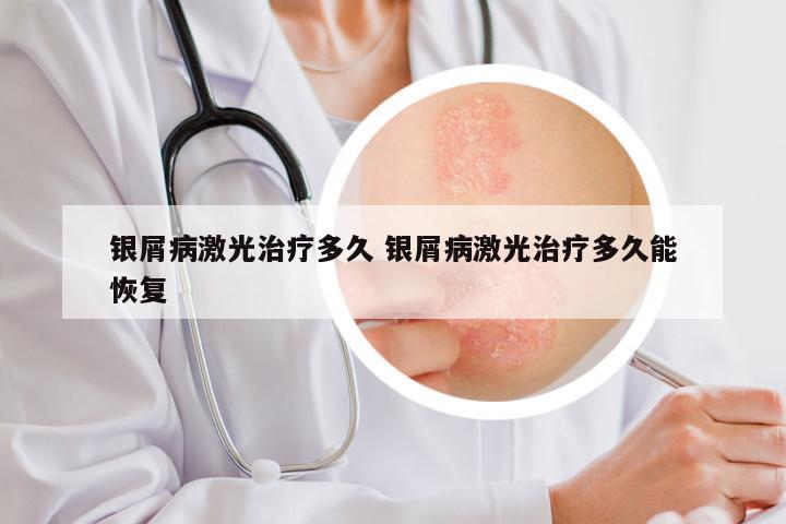 银屑病激光治疗多久 银屑病激光治疗多久能恢复