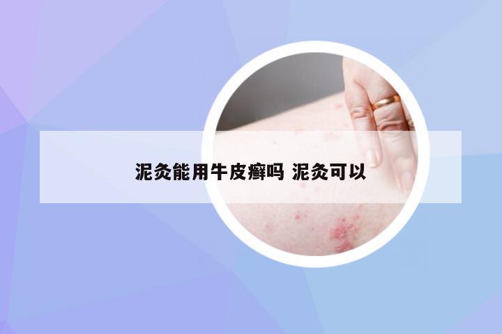 泥灸能用牛皮癣吗 泥灸可以