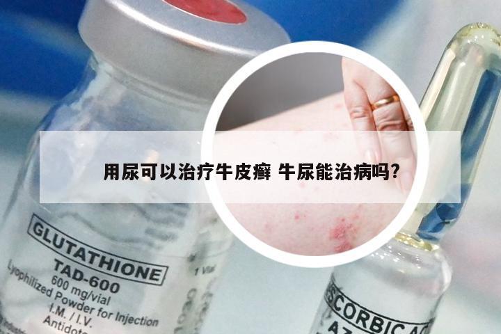 用尿可以治疗牛皮癣 牛尿能治病吗?