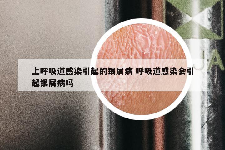 上呼吸道感染引起的银屑病 呼吸道感染会引起银屑病吗