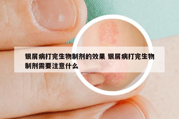 银屑病打完生物制剂的效果 银屑病打完生物制剂需要注意什么