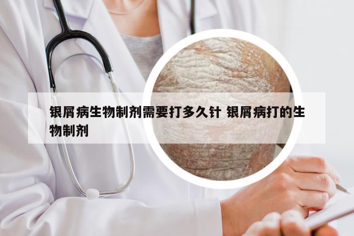 银屑病生物制剂需要打多久针 银屑病打的生物制剂