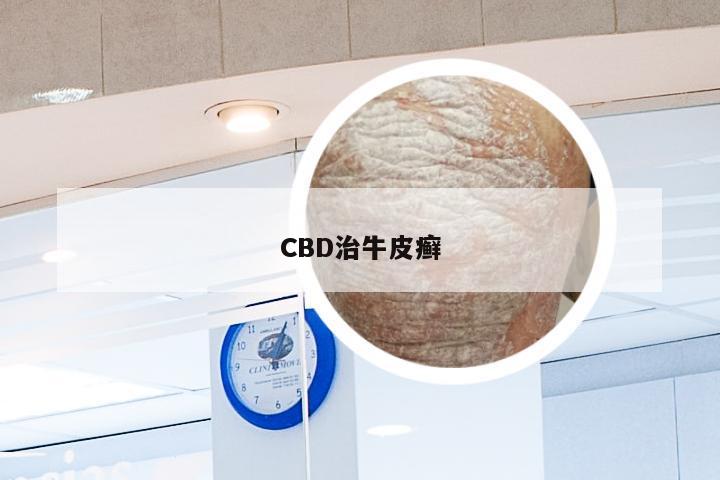 CBD治牛皮癣