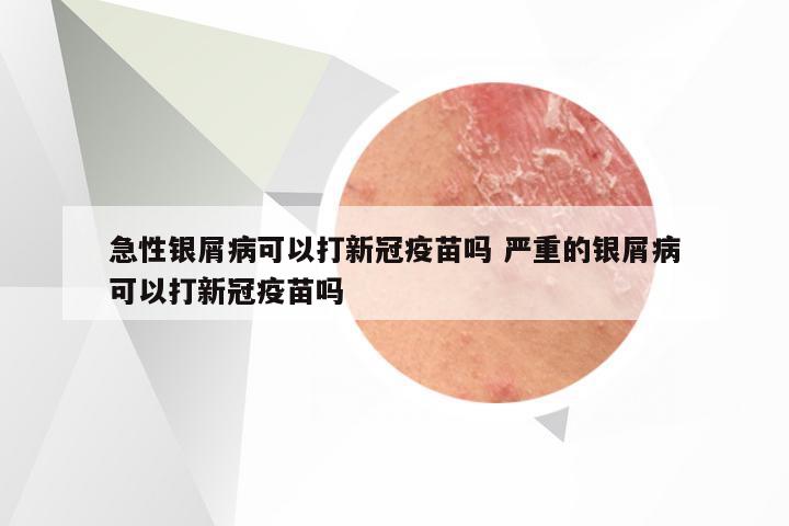 急性银屑病可以打新冠疫苗吗 严重的银屑病可以打新冠疫苗吗