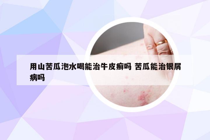 用山苦瓜泡水喝能治牛皮癣吗 苦瓜能治银屑病吗