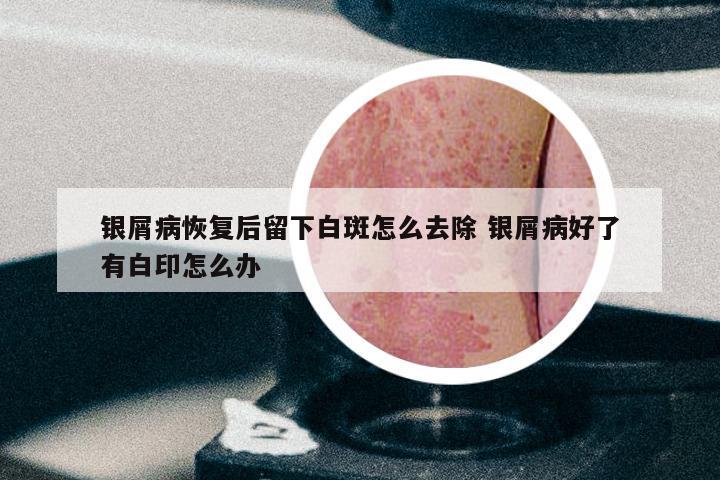 银屑病恢复后留下白斑怎么去除 银屑病好了有白印怎么办