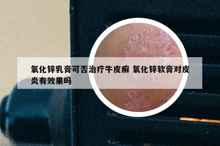 氧化锌乳膏可否治疗牛皮癣 氧化锌软膏对皮炎有效果吗