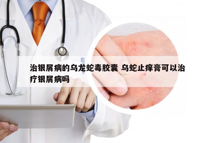 治银屑病的乌龙蛇毒胶囊 乌蛇止痒膏可以治疗银屑病吗