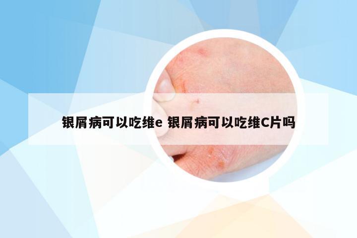 银屑病可以吃维e 银屑病可以吃维C片吗