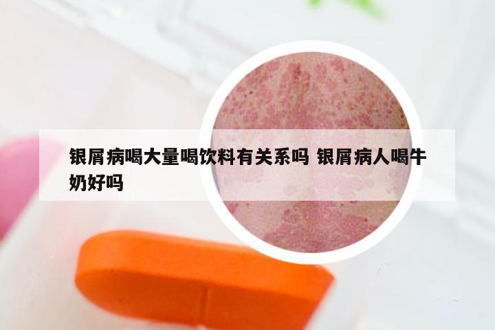 银屑病喝大量喝饮料有关系吗 银屑病人喝牛奶好吗