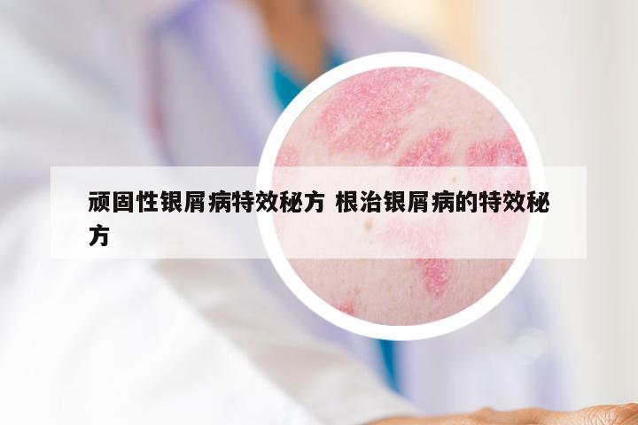 顽固性银屑病特效秘方 根治银屑病的特效秘方