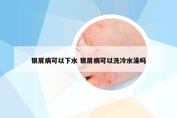 银屑病可以下水 银屑病可以洗冷水澡吗