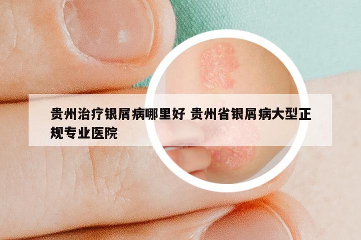 贵州治疗银屑病哪里好 贵州省银屑病大型正规专业医院