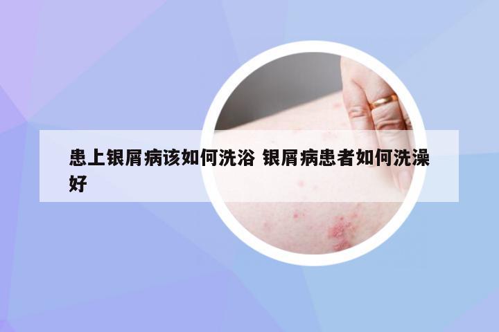 患上银屑病该如何洗浴 银屑病患者如何洗澡好