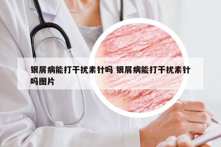 银屑病能打干扰素针吗 银屑病能打干扰素针吗图片