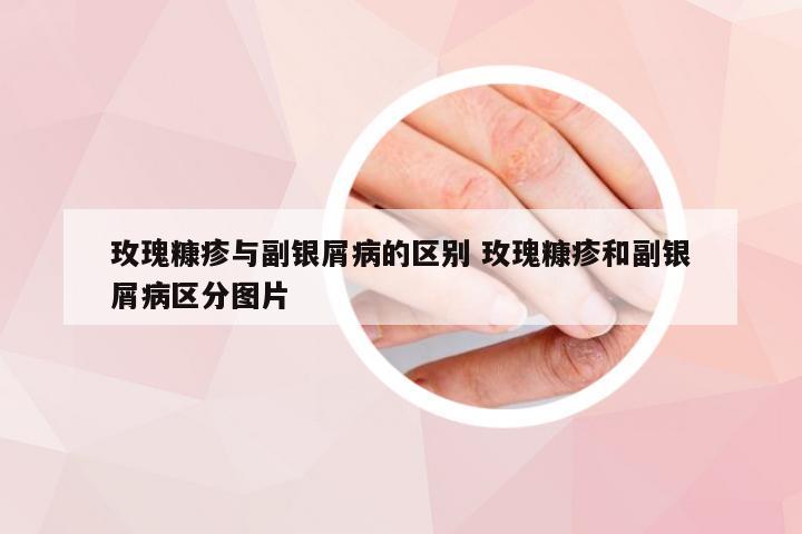 玫瑰糠疹与副银屑病的区别 玫瑰糠疹和副银屑病区分图片