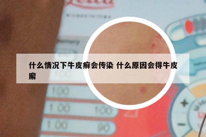 什么情况下牛皮癣会传染 什么原因会得牛皮廨