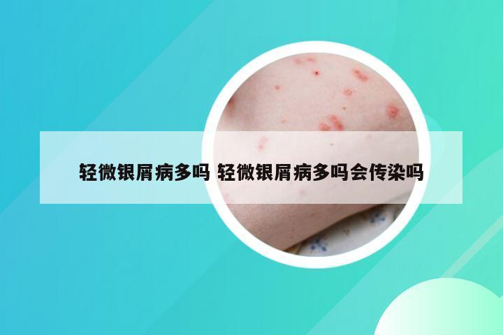 轻微银屑病多吗 轻微银屑病多吗会传染吗