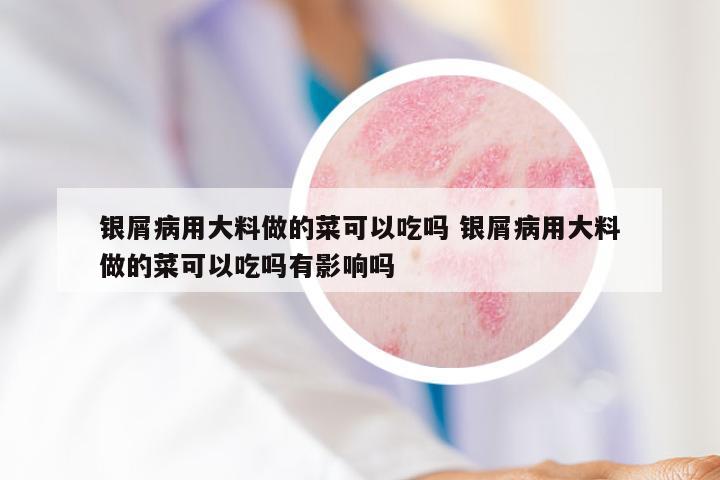 银屑病用大料做的菜可以吃吗 银屑病用大料做的菜可以吃吗有影响吗