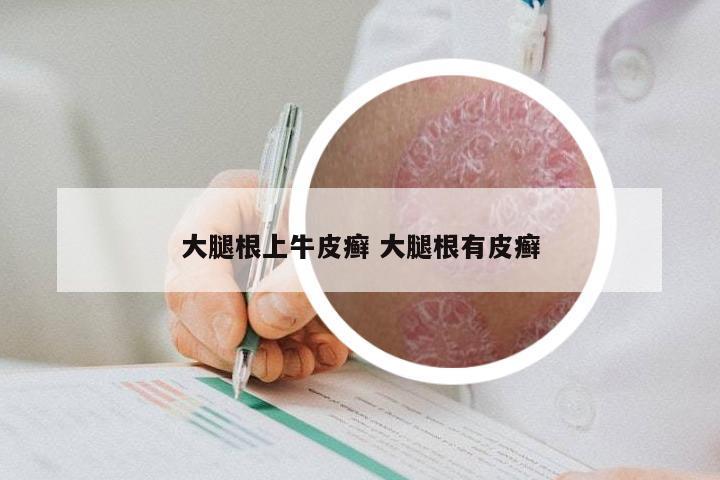 大腿根上牛皮癣 大腿根有皮癣