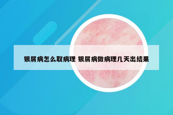 银屑病怎么取病理 银屑病做病理几天出结果