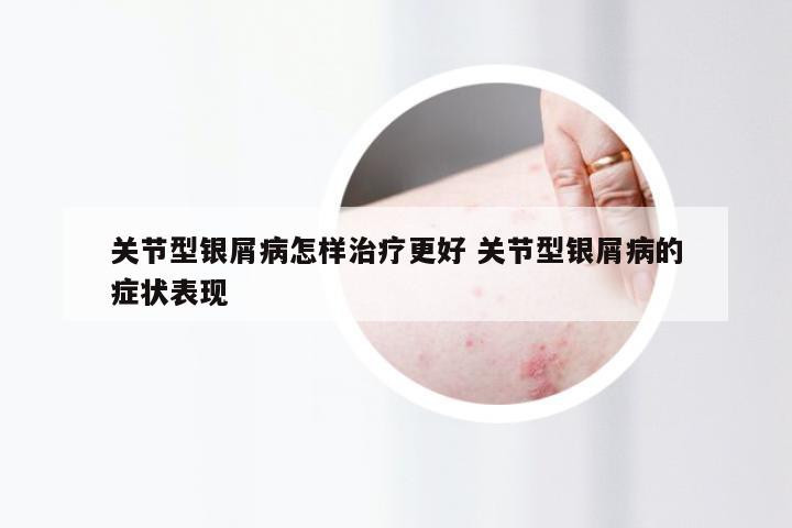 关节型银屑病怎样治疗更好 关节型银屑病的症状表现