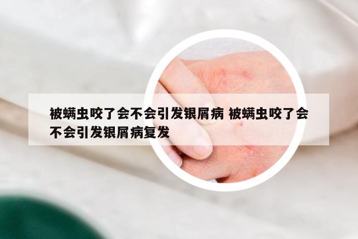 被螨虫咬了会不会引发银屑病 被螨虫咬了会不会引发银屑病复发