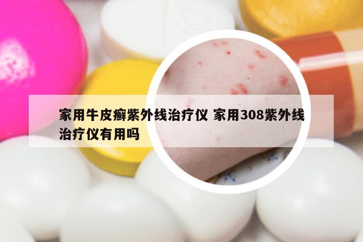 家用牛皮癣紫外线治疗仪 家用308紫外线治疗仪有用吗